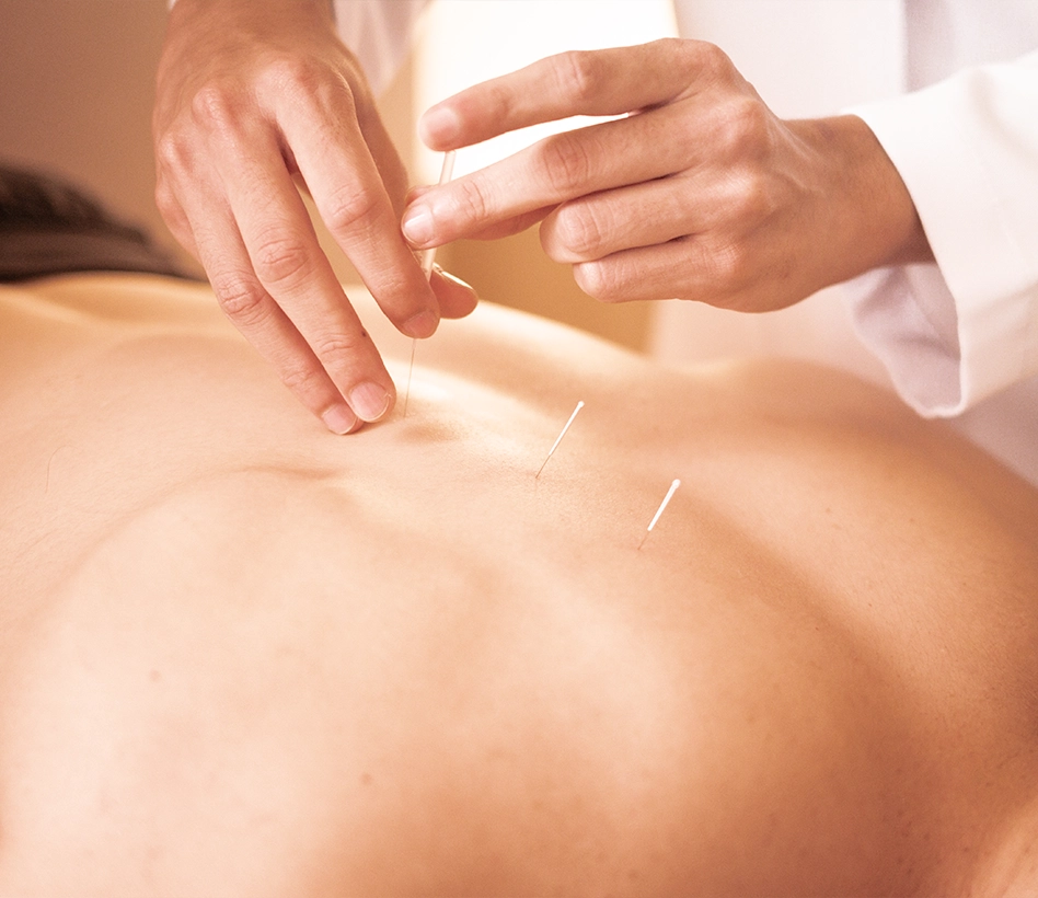 Acupuncture