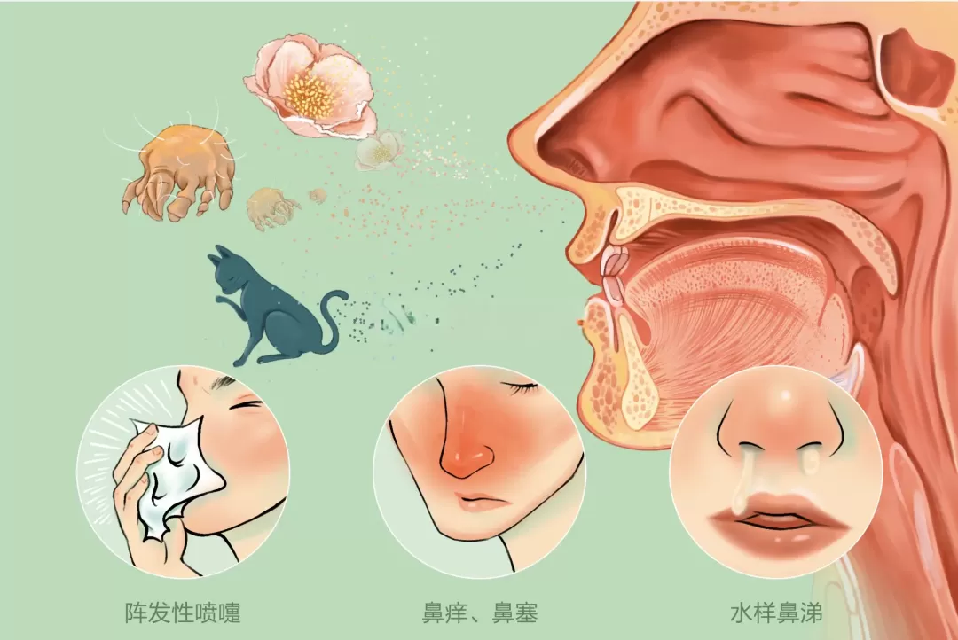 过敏性鼻炎中医怎么调理？新加坡贡方堂TCM丘保润有一方，药简效高！