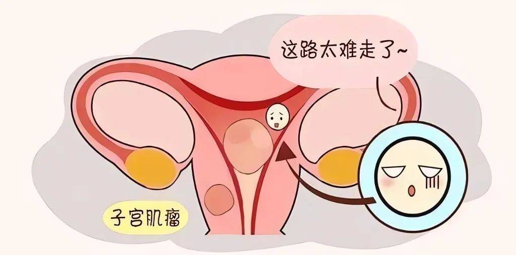 子宫肌瘤中医怎么调理？新加坡贡方堂TCM丘保润有良方效果好！