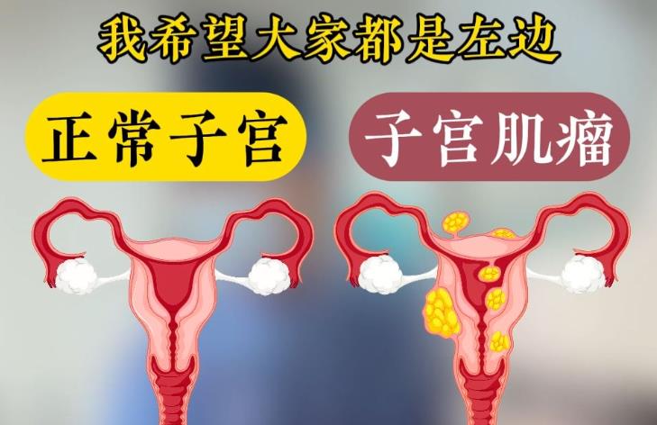 子宫肌瘤中医怎么调理？贡方堂TCM丘保润有消瘤方！