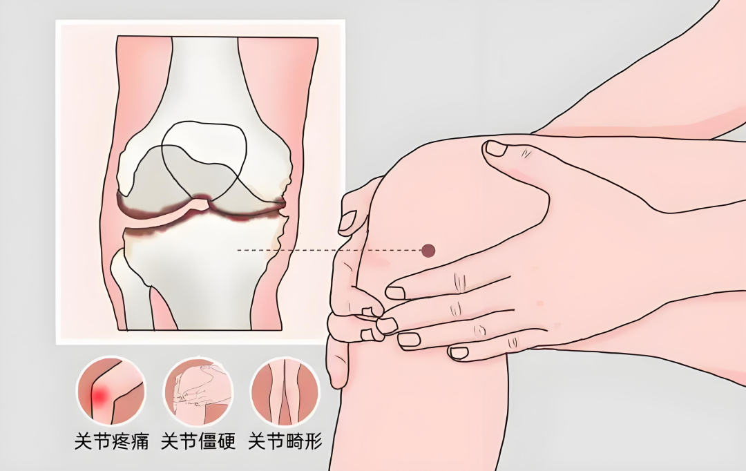 新加坡关节疼痛中医治疗