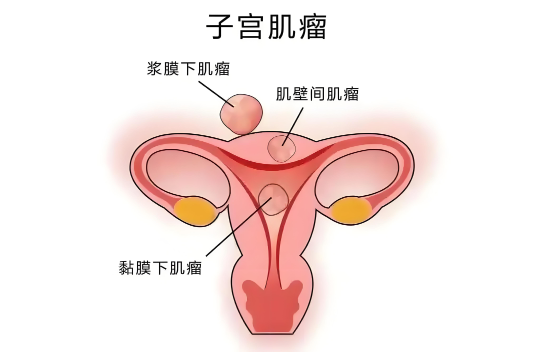 子宫肌瘤怎么办？新加坡贡方堂TCM丘保润一方有奇效！